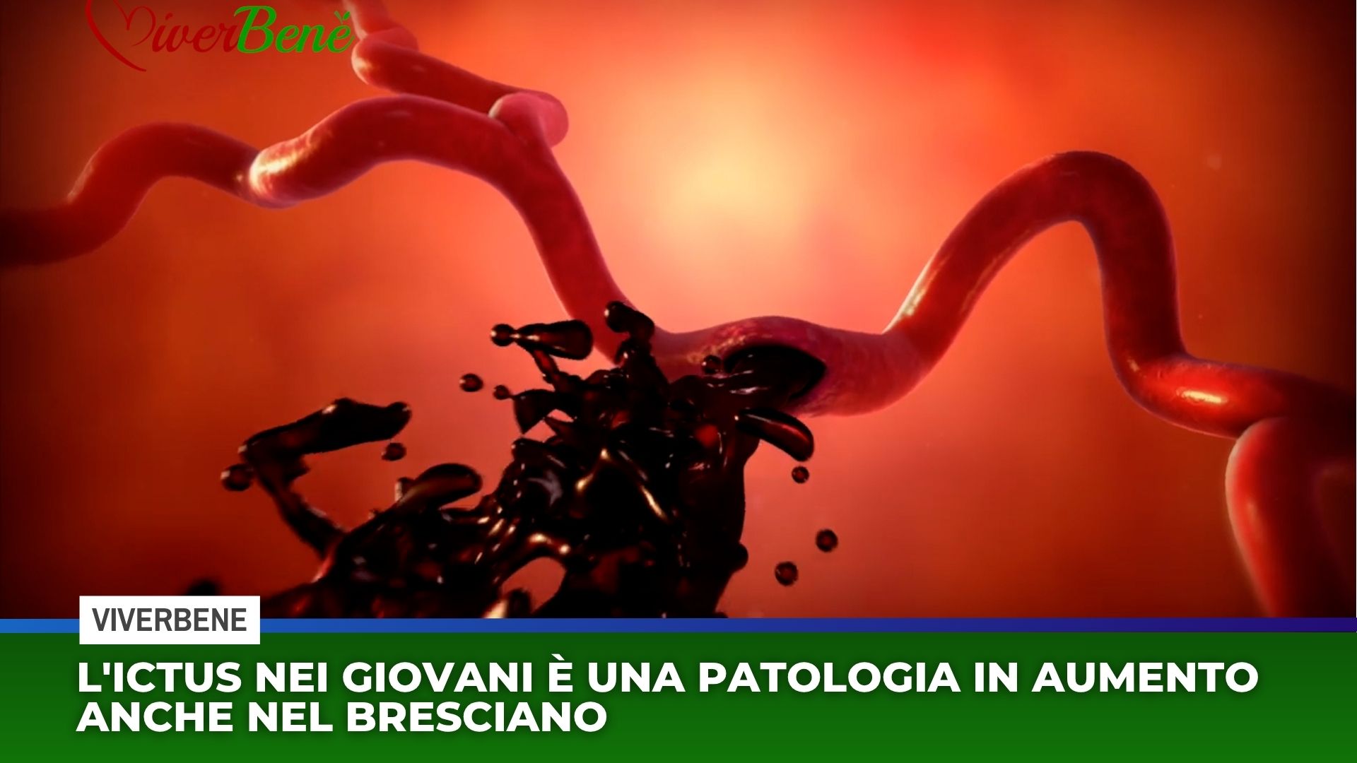 L'ictus nei giovani è una patologia in aumento anche nel bresciano